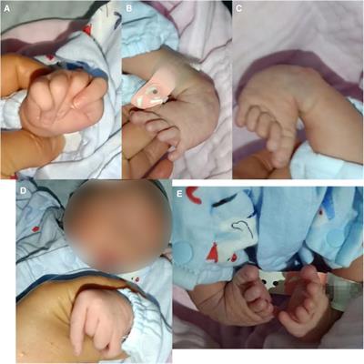 Case Report: New presentation of CLIFAHDD syndrome with a novel variant in the NALCN gene and a literature review